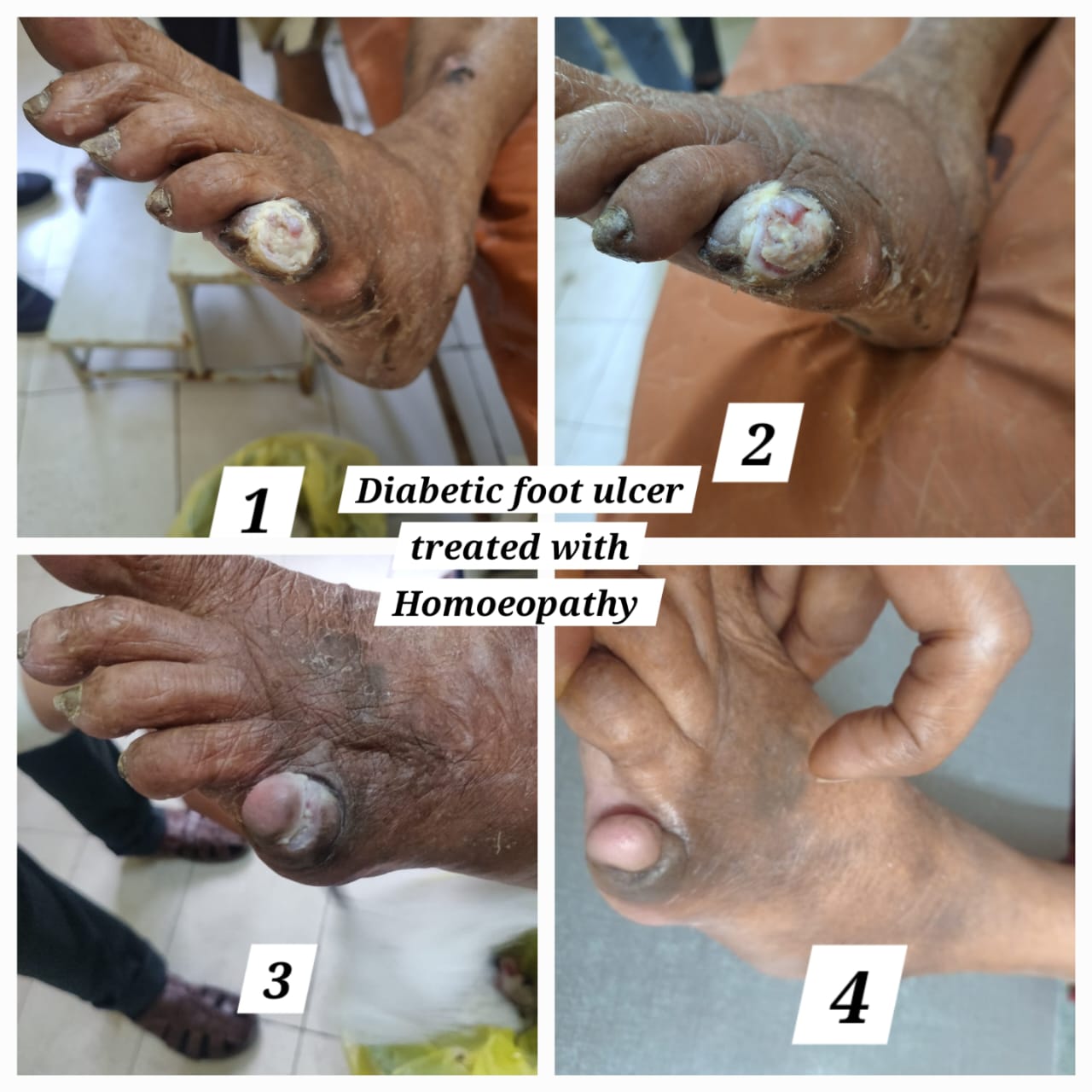 Diabetic foot ulcer treatment